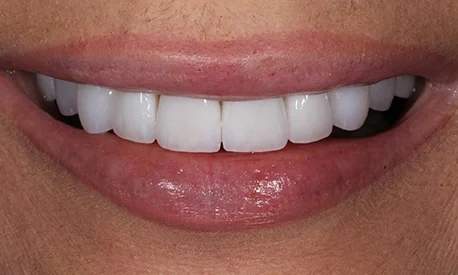 After: the same smile widened and brightened with veneers.