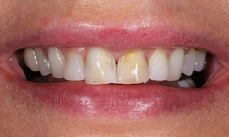 Before: a narrow smile with a discolored front tooth.