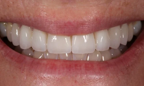 After: the same smile with new, more natural veneers.