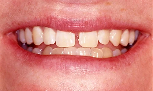Before: older veneers with spaces and rotated lower teeth.