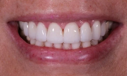 After: the same smile with eight porcelain veneers on the upper teeth.
