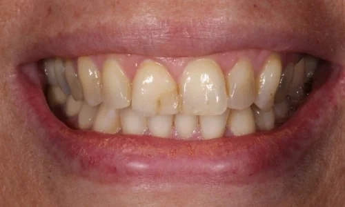 Before: a smile with a stained, repeatedly bonded front tooth.