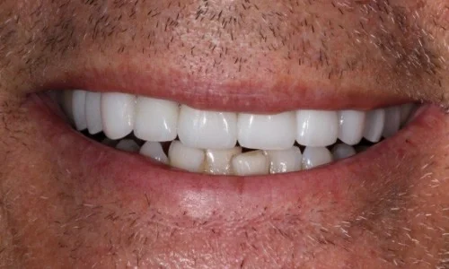 After: the same smile restored with crowns and veneers.