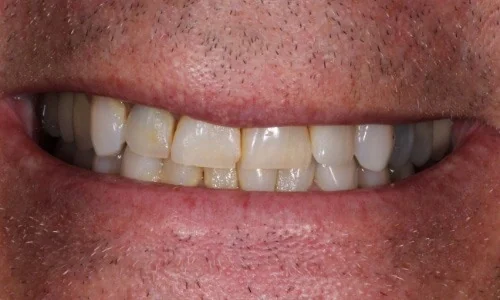 Before: a smile with worn and uneven upper teeth.